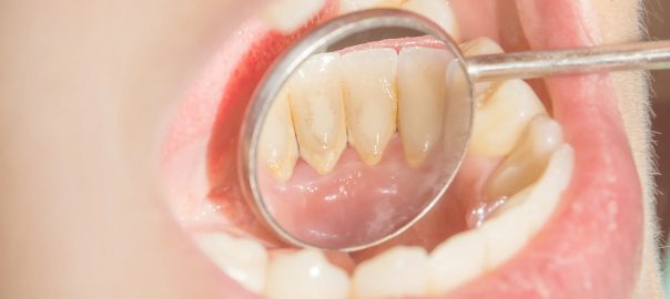 Dental Cleaning in Punjabi Bagh